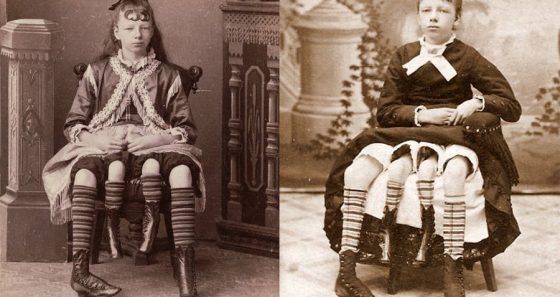 10 personnes qui ont été dans des cirques humains à cause de leur difformité ! Quotes   