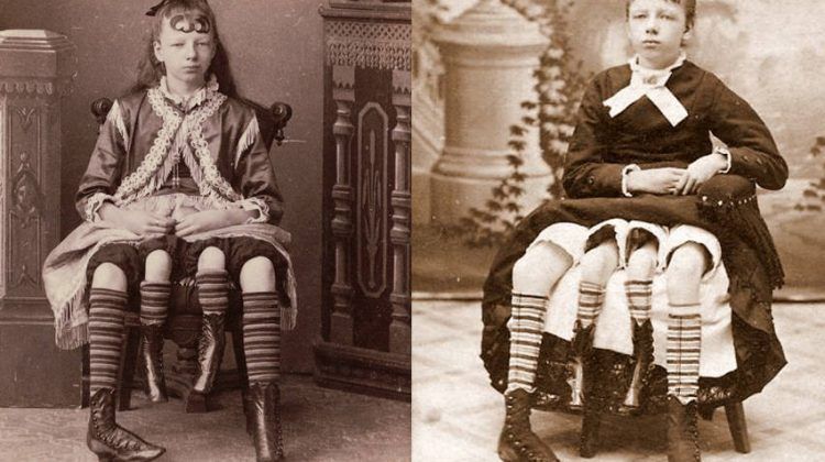 10 personnes qui ont été dans des cirques humains à cause de leur difformité ! Quotes   